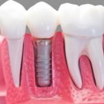 implante-dental- clínica dental en Ávila