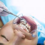 apiñamiento dental-dientes tiburón