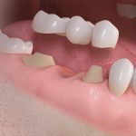 Clínica Dental Arancha Otero - Implante dental o Puente dental