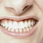 Clínica Dental Arancha Otero - Bruxismo