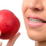 Clínica Dental Arancha Otero - Alimentos y Ortodoncia