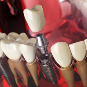 priimplantitis en implantes dentales